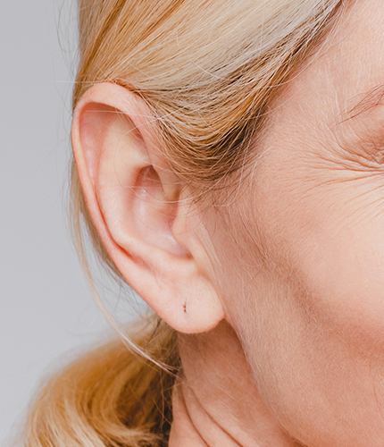 Repairing Gauge or Stretched Earlobes with Plastic Surgery